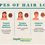 types-of-hair-loss---picture-data