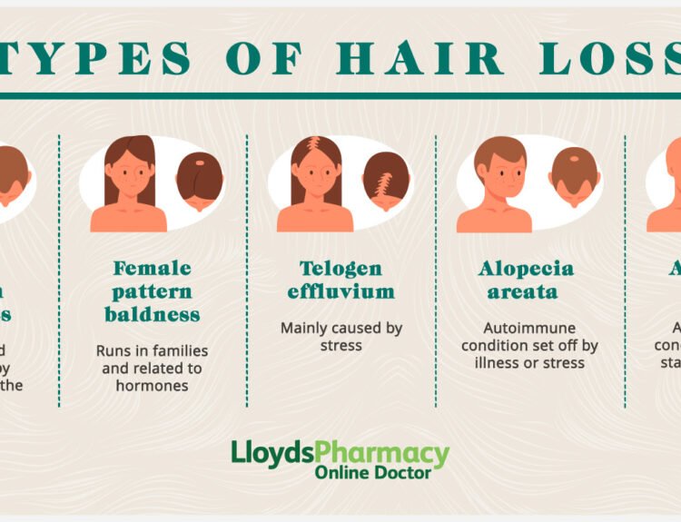 types-of-hair-loss---picture-data